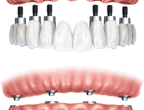 L’entretien des implants dentaires : un geste essentiel pour leur longévité